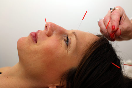 Acupuncturist Los Angeles