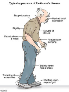 Parkinson Disease graphic